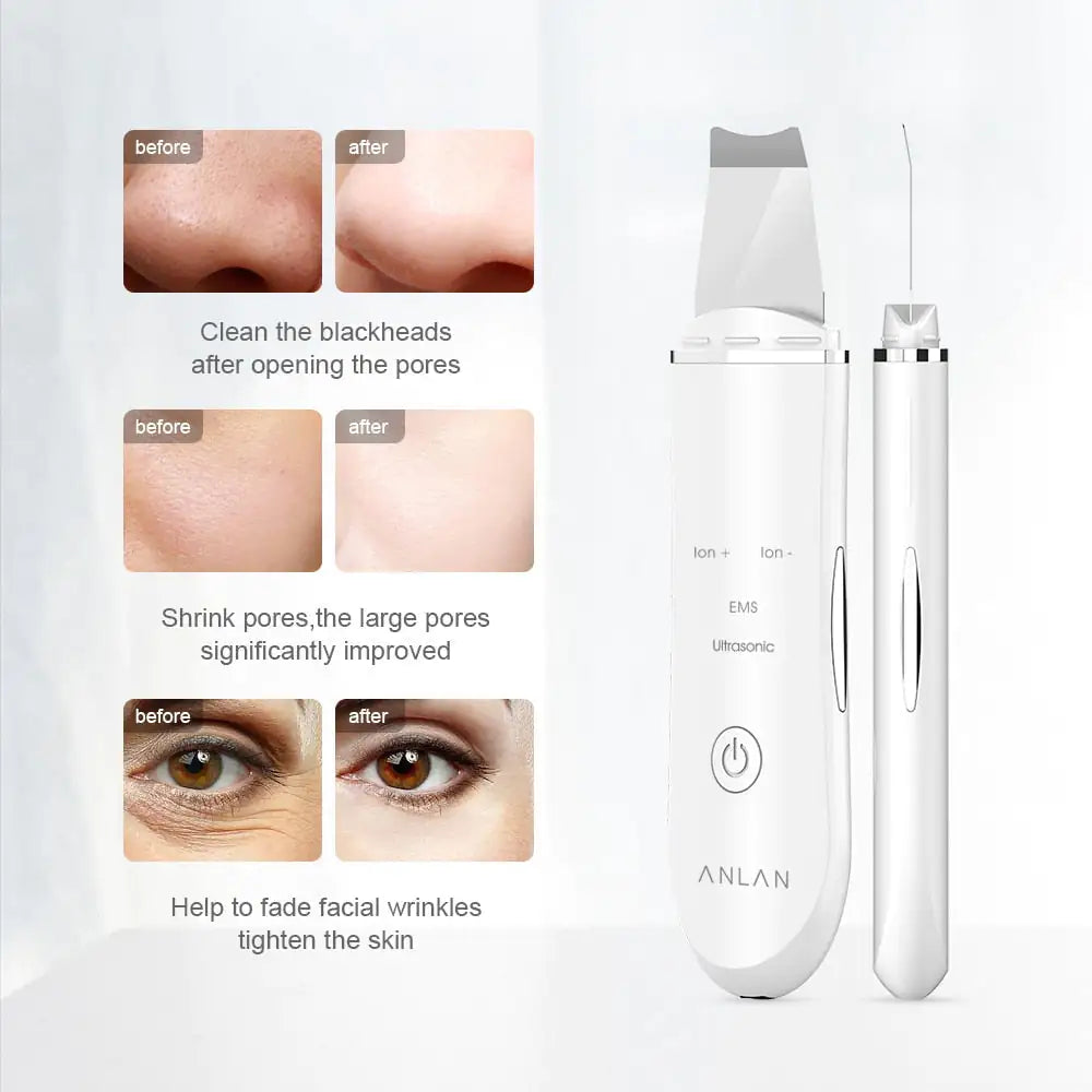 Ultrasonic Skin Scrubber - MyRTouch